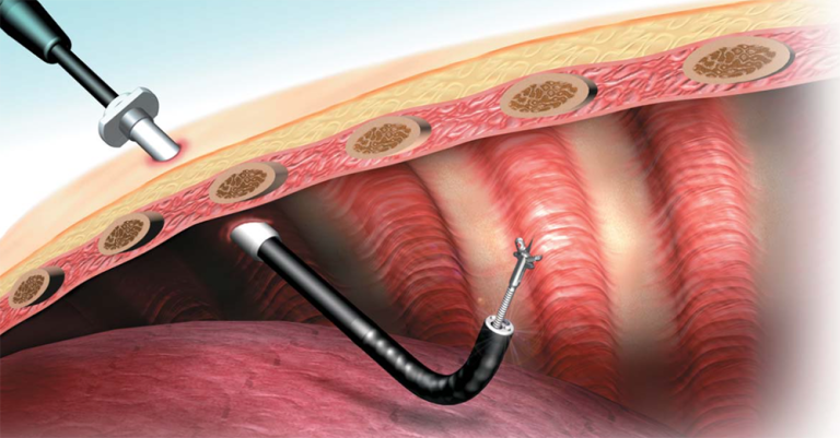 Thoracoscopy procedure by Dr. Sameer Arbat, Nagpur