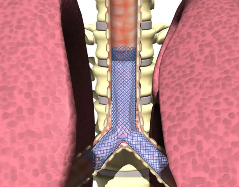 Airway stenting illustration showing stent placement in the trachea
