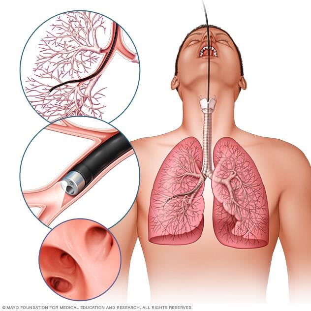 Bronchoscopy illustration showing procedure