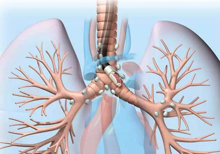 EBUS endobronchial ultrasound illustration
